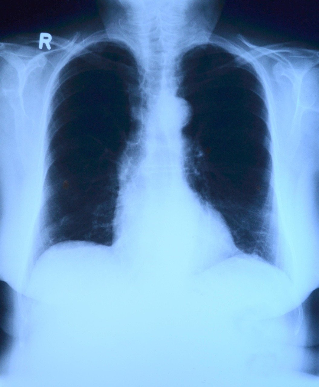 x-ray image, roentgen, thorax, lung x-ray, medicine, roentgen, roentgen, roentgen, roentgen, roentgen